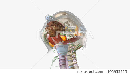 Stage four oral cancer is invasive and has spread beyond the tissue in which it first appeared. 103953525