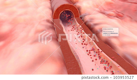 Due to increase of sodium and aldosterone in the blood artery constrict 103953527