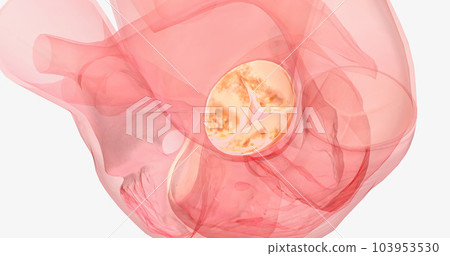 This is known as aortic insufficiency, or aortic regurgitation. 103953530