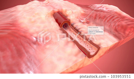 Due to increase of sodium and aldosterone in the blood artery constrict 103953551