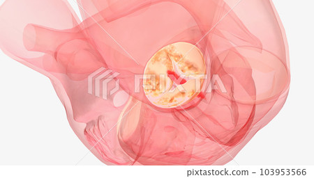 This is known as aortic insufficiency, or aortic regurgitation. 103953566