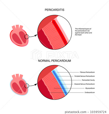Pericarditis heart disease Pericarditis heart disease 103959724