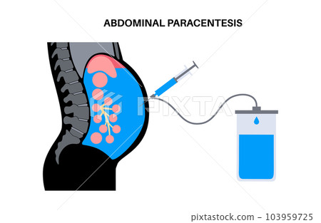 Abdominal paracentesis poster Abdominal paracentesis poster 103959725