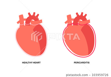 Pericarditis heart disease Pericarditis heart disease 103959726