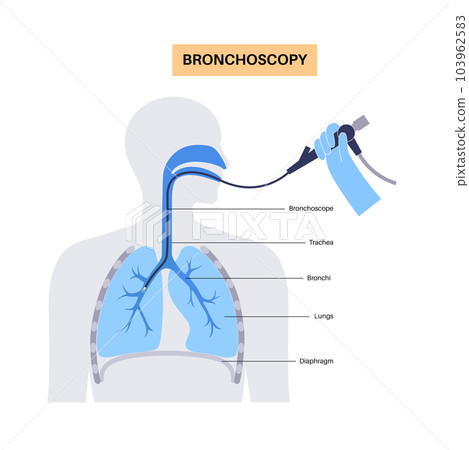 Bronchoscopy procedure concept 103962583
