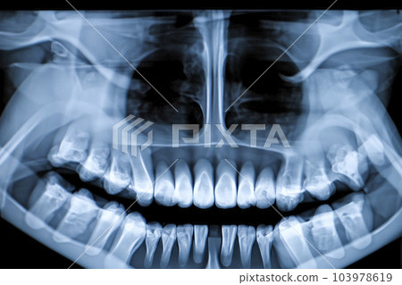 X-ray. X-ray of head, foot, head, mouth, ribs and hands. Bone scan. Body injury. X-ray analysis of human teeth. Xray of a human thorax isolated 103978619