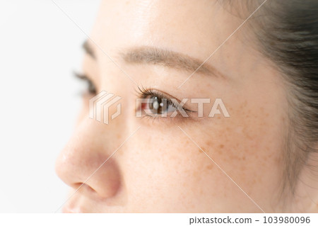 Age spots chloasma pimples women 103980096