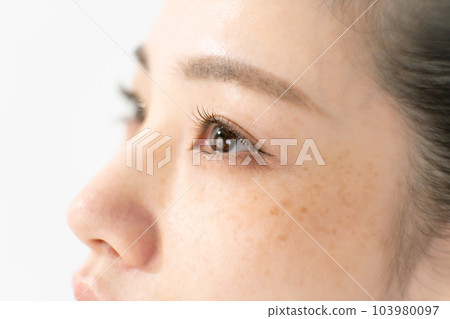 Age spots chloasma pimples women Age spots chloasma pimples women 103980097