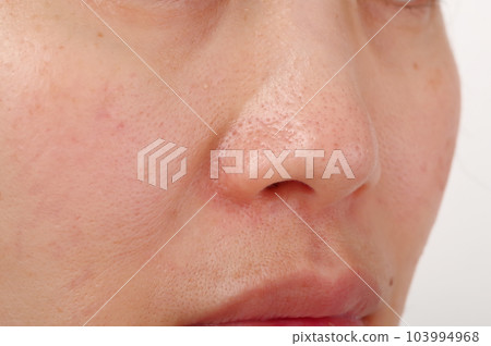 40多歲女人鼻子周圍 40多歲女人鼻子周圍 103994968