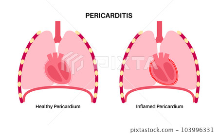 Pericarditis heart disease Pericarditis heart disease 103996331