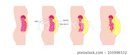Visceral fat diagram Visceral fat diagram 103996332