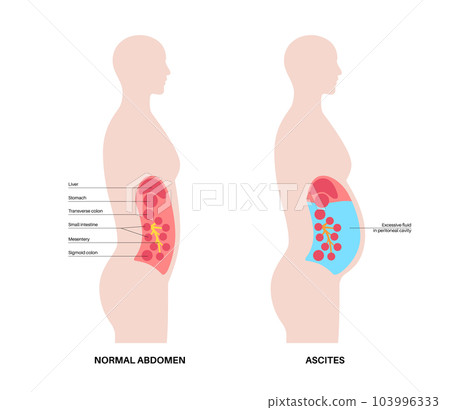 Ascites disease poster Ascites disease poster 103996333