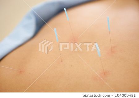 Acupuncture and moxibustion Acupuncture and moxibustion 104000481