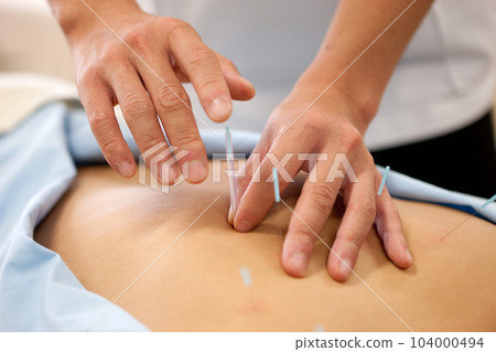 Acupuncture and moxibustion 104000494