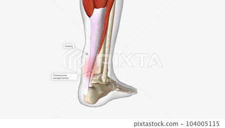 An ankle strain occurs when the muscles or tendons around the ankle are stretched too far. An ankle strain occurs when the muscles or tendons around the ankle are stretched too far. 104005115