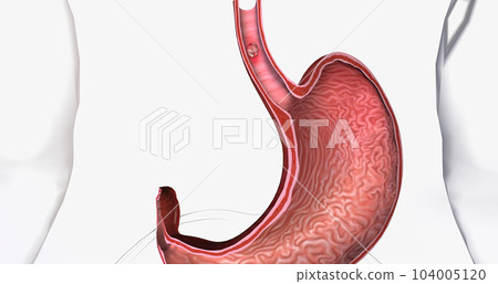 Squamous cell carcinoma, Cancer that forms in the thin, flat cells lining the inside of the esophagus. 104005120