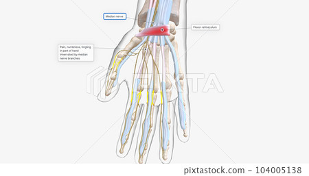 Carpal Tunnel Syndrome - Wrist Pain isolated on white (transparent bones) 104005138