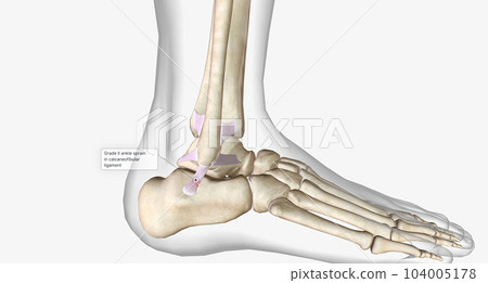 Grade II ankle sprain 3d 104005178