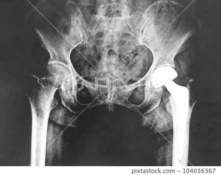 x-ray of hip replacement surgery x-ray of hip replacement surgery 104036367