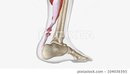 Flexion and Extension with Torn Achilles Tendon 104036393