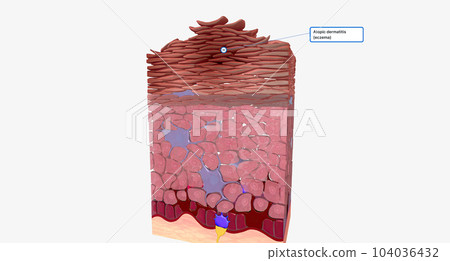 Eczema at the Cellular Level 104036432