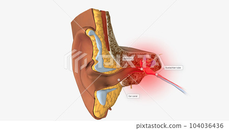 Earache is a general term for pain in the ear. Earache is a general term for pain in the ear. 104036436