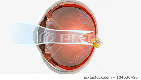 Astigmatism is an eye condition characterized by an oval-shaped cornea and blurry vision. 104036450