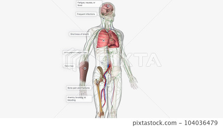 The AML, Signs and Symptoms 104036479