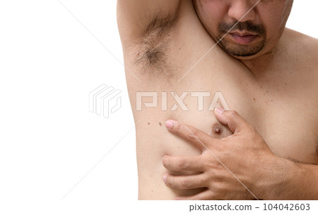 Close up the skin tags on man's skin under the armpits and sides of the body 104042603