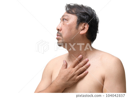 Asia middle age senior man point to skin tags or acrochordon on his neck Asia middle age senior man point to skin tags or acrochordon on his neck 104042837