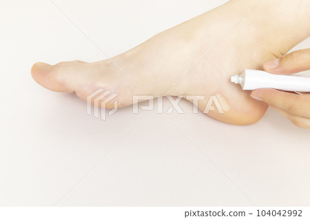 Foot with Healing Cream, Ointment Near Calluses, Skin Corns on Heel and Phalange of Toe. Water Blister Disease On Feet. Person Shows Painful Callosity Before Treatment. Closeup Horizontal. Copyspace. 104042992