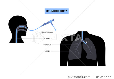 Bronchoscopy procedure concept Bronchoscopy procedure concept 104058366