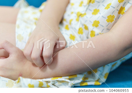 Little girl has skin rash allergy itching and scratching on her arm Little girl has skin rash allergy itching and scratching on her arm 104060955