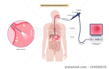 Gastroscopy endoscopy procedure 104080876