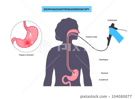 Gastroscopy endoscopy procedure 104080877