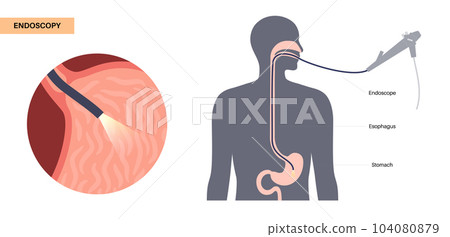 Gastroscopy endoscopy procedure 104080879