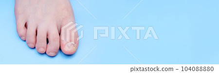 Banner Unibrace system on the leg of a teenager in the treatment of an ingrown nail, On a blue background. Toenail Correction System Banner Unibrace system on the leg of a teenager in the treatment of an ingrown nail, On a blue background. Toenail Correction System 104088880