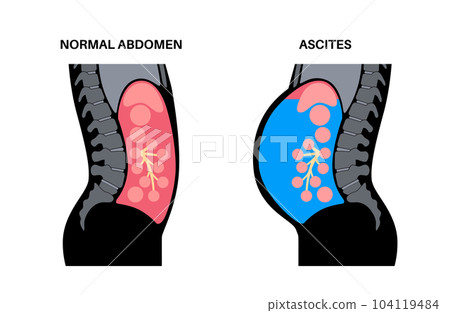Ascites disease poster Ascites disease poster 104119484