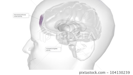 Anxiety is a neurological condition characterized by persistent, uncontrollable worry accompanied by emotional distress. Anxiety is a neurological condition characterized by persistent, uncontrollable worry accompanied by emotional distress. 104130239