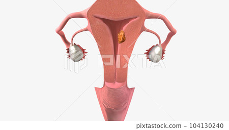 Stage I endometrial cancer begins in the endometrium and spreads to the myometrium of the uterus 104130240