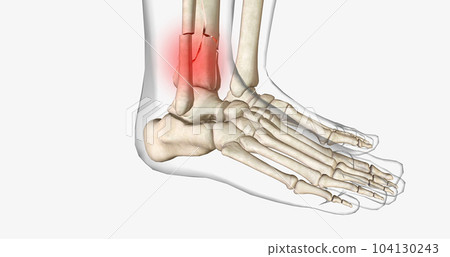 Distal tibia fractures affect the ankle joint and can often involve a fracture of the fibula. Distal tibia fractures affect the ankle joint and can often involve a fracture of the fibula. 104130243