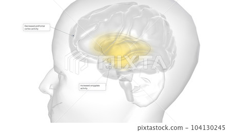 Anxiety is a neurological condition characterized by persistent, uncontrollable worry accompanied by emotional distress. Anxiety is a neurological condition characterized by persistent, uncontrollable worry accompanied by emotional distress. 104130245