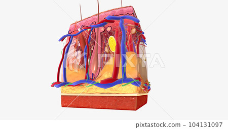 Angioedema is a swelling of the dermis and subcutaneous tissue. 104131097