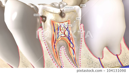 Dental caries, or cavities, are areas of tooth decay caused by acid-producing bacteria in the mouth. 104131098