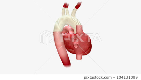 The enlarged portion of the aortic arch is replaced with a synthetic graft. The enlarged portion of the aortic arch is replaced with a synthetic graft. 104131099