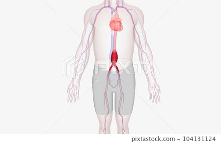 Abdominal aortic aneurysm occurs when the abdominal aorta balloons out due to the weakening of the wall of the artery. Abdominal aortic aneurysm occurs when the abdominal aorta balloons out due to the weakening of the wall of the artery. 104131124