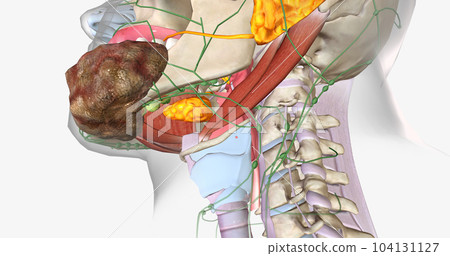 Stage four oral cancer is invasive and has spread beyond the tissue in which it first appeared. Stage four oral cancer is invasive and has spread beyond the tissue in which it first appeared. 104131127
