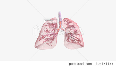 Inflammation and constriction of airways 104131133