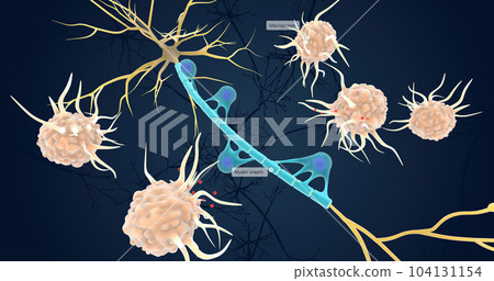 Autoimmune Attack on Myelin Sheath 104131154