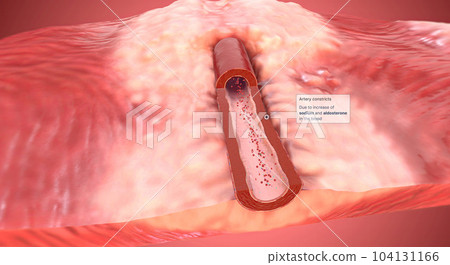 Due to increase of sodium and aldosterone in the blood artery constrict 104131166